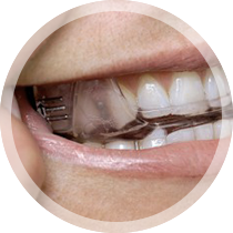 Closeup of smile with oral appliance