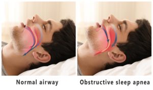 obstructive sleep apnea