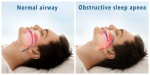 sleep apnea