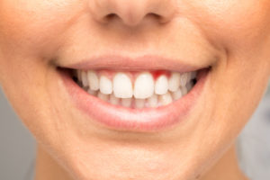 Close up of woman's smile with gum disease 